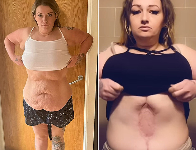 Po plastice břicha nastaly komplikace, žena zůstala zohyzděná